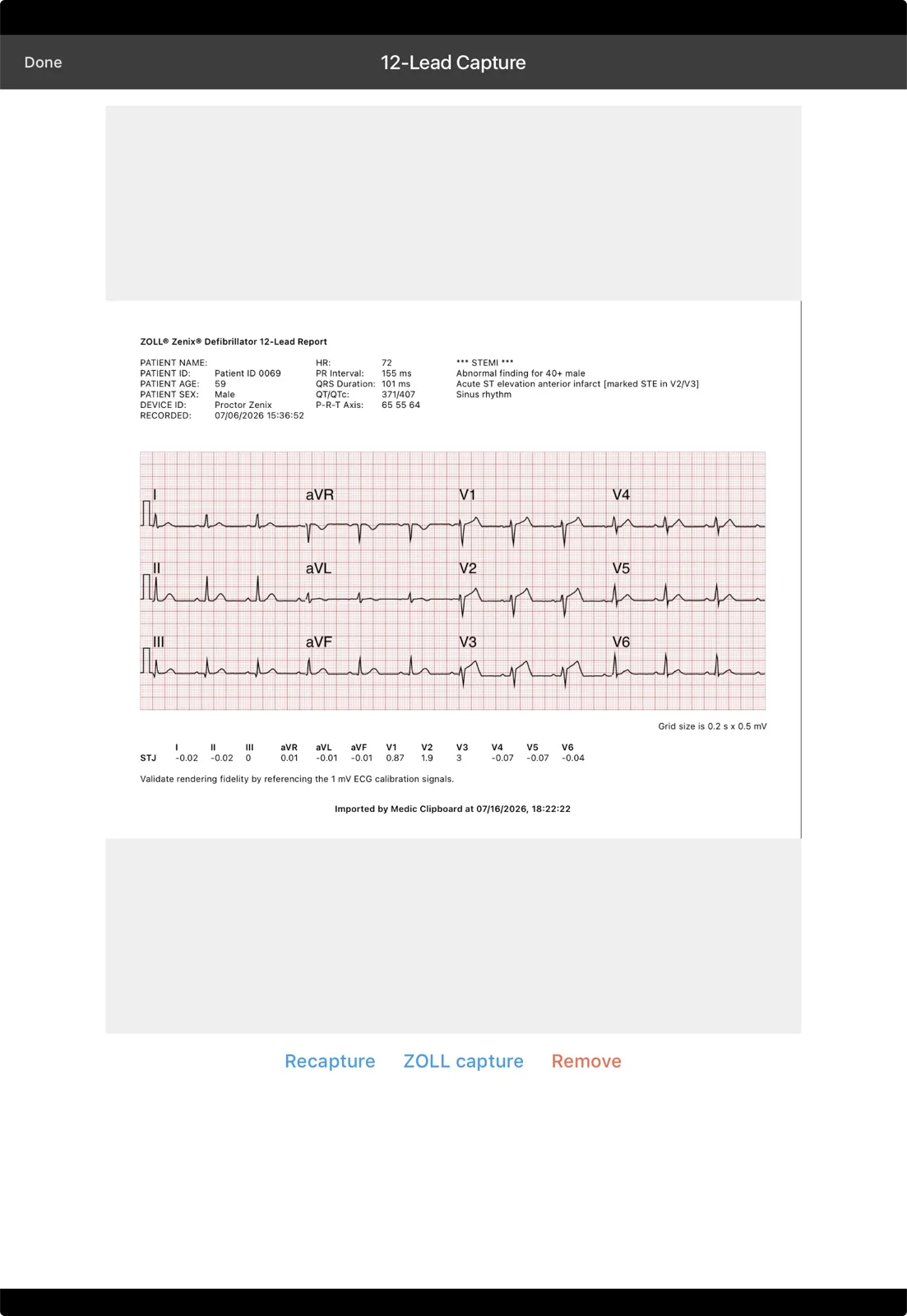 Mobile Medic 12-Lead Capture screen on iPad showing an imported ZOLL 12-lead report with a STEMI interpretation, the full 12-lead tracing, and Recapture, ZOLL capture and Remove buttons
